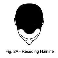 Receding Hairline