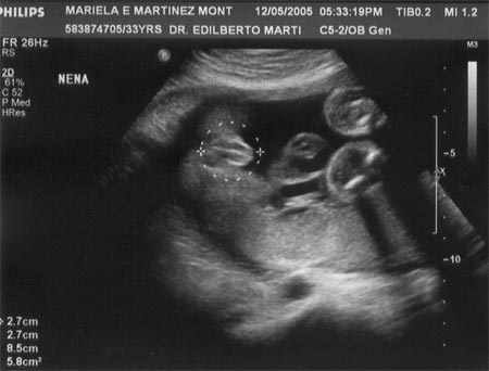 Sonograma 1